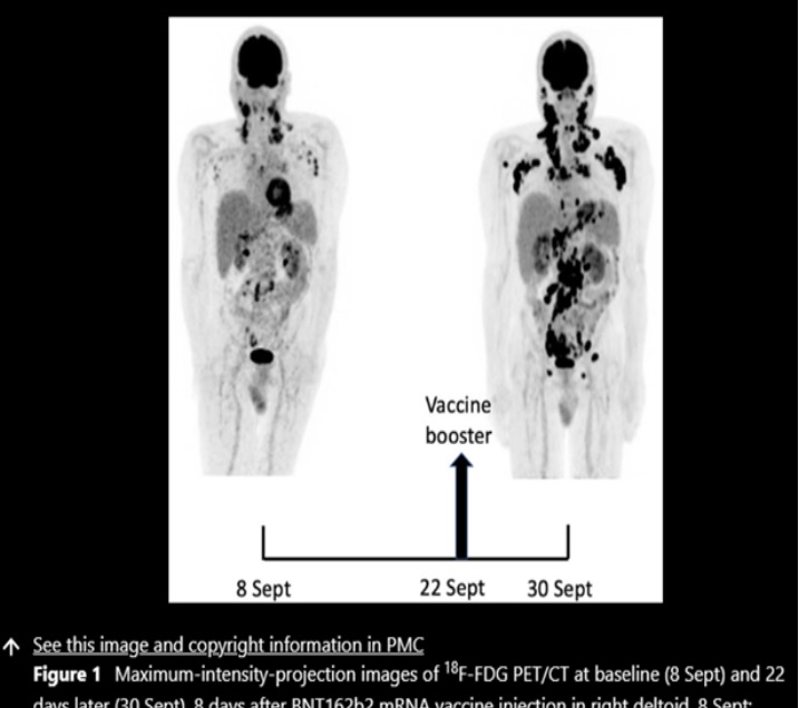 Immagine PET di un linfoma insorto dopo richiamo di vaccino anti COVID-19 della Pfizer